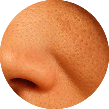 ⁠צמצום נקבוביות פעורות