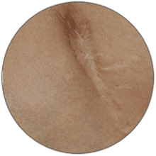 טיפול בסימני מתיחה