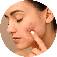 אקנה ודלקות עור