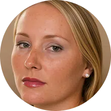 היפר פיגמנטציה