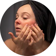 הפחתת דלקת בעור